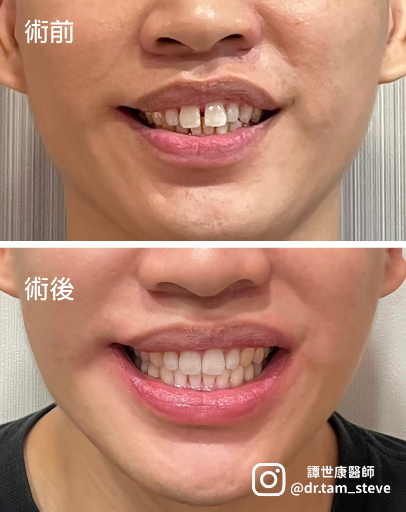 20220623invisalign case ba2